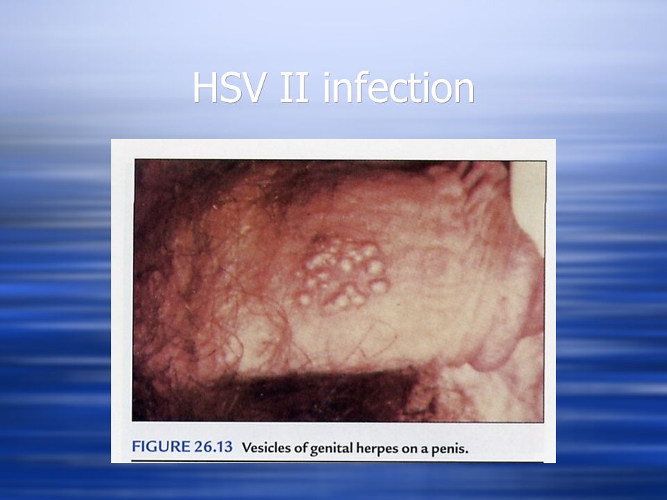 HSV II infection
