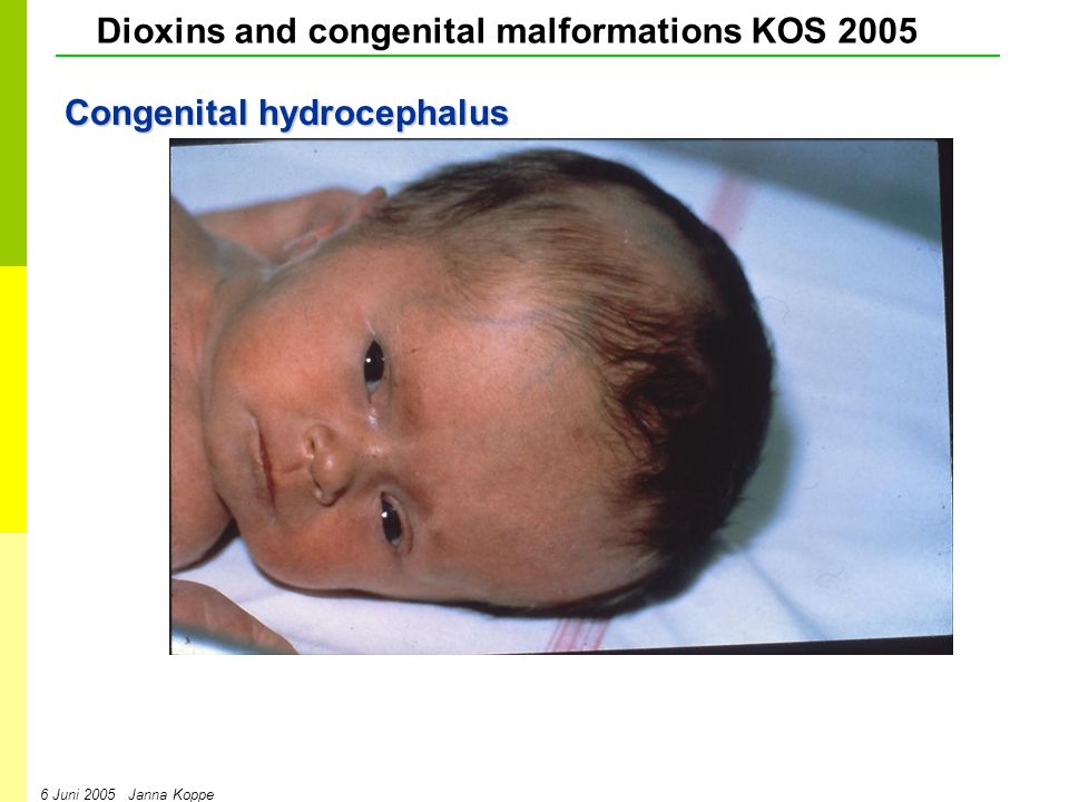Dioxins and congenital malformations KOS Juni 2005 Janna Koppe Congenital hydrocephalus