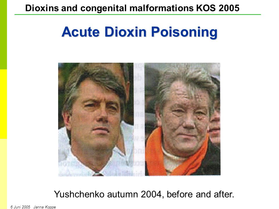 Dioxins and congenital malformations KOS Juni 2005 Janna Koppe Acute Dioxin Poisoning Yushchenko autumn 2004, before and after.