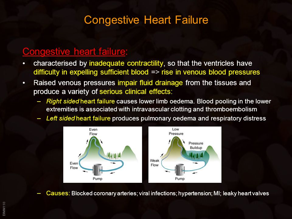 BIMM118 Congestive Heart Failure Congestive heart failure: characterised by inadequate contractility, so that the ventricles have difficulty in expelling sufficient blood => rise in venous blood pressures Raised venous pressures impair fluid drainage from the tissues and produce a variety of serious clinical effects: –Right sided heart failure causes lower limb oedema.