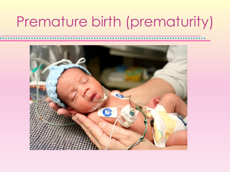 Premature birth (prematurity)