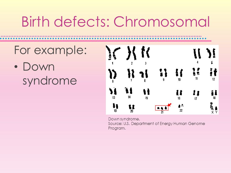 Birth defects: Chromosomal For example: Down syndrome Down syndrome.