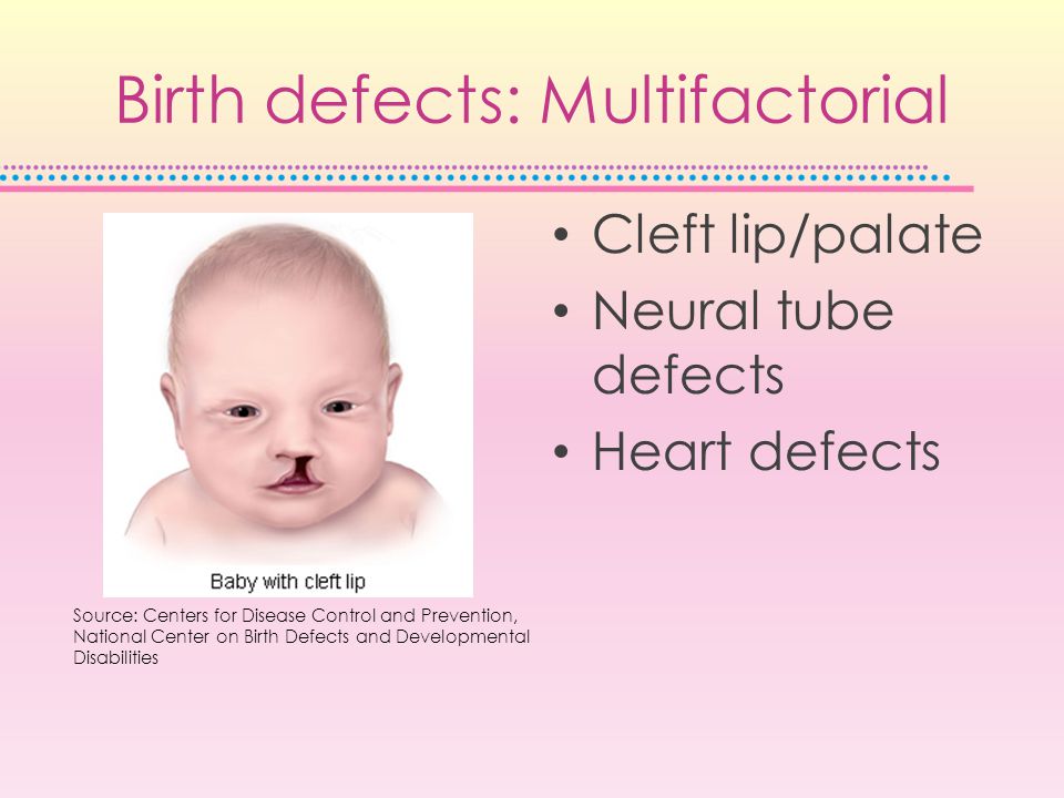 Birth defects: Multifactorial Cleft lip/palate Neural tube defects Heart defects Source: Centers for Disease Control and Prevention, National Center on Birth Defects and Developmental Disabilities