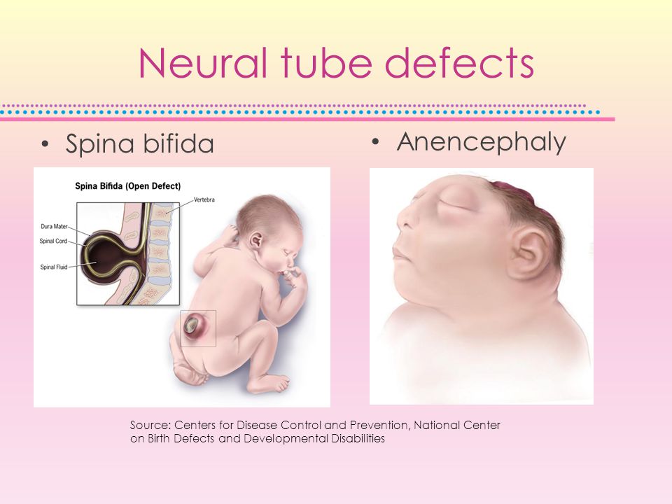 Neural tube defects Anencephaly Spina bifida Source: Centers for Disease Control and Prevention, National Center on Birth Defects and Developmental Disabilities