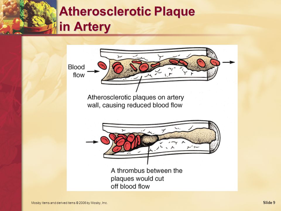 Mosby items and derived items © 2006 by Mosby, Inc. Slide 9 Atherosclerotic Plaque in Artery