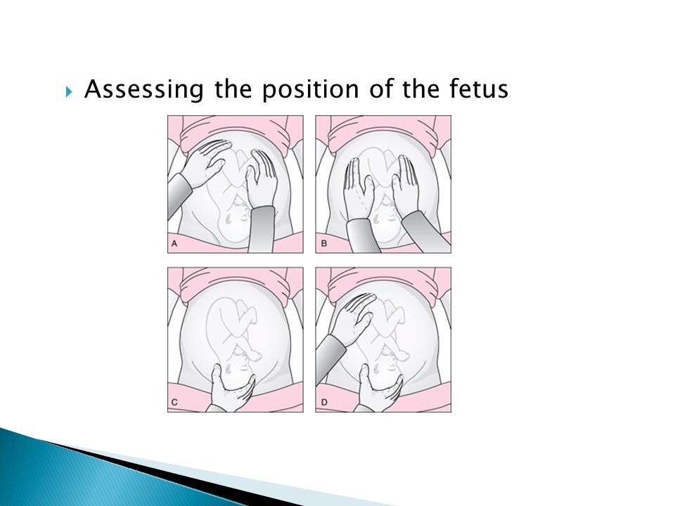  Assessing the position of the fetus