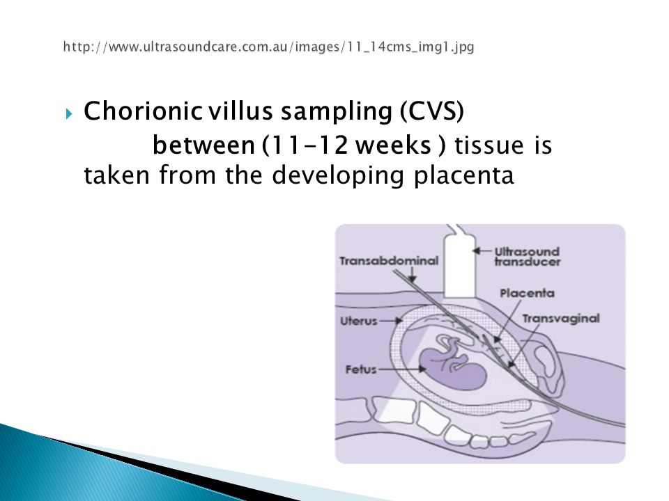  Chorionic villus sampling (CVS) between (11-12 weeks ) tissue is taken from the developing placenta