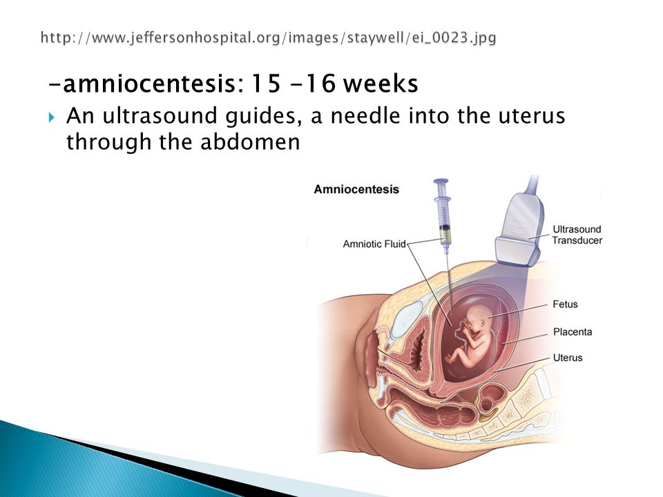 -amniocentesis: weeks  An ultrasound guides, a needle into the uterus through the abdomen