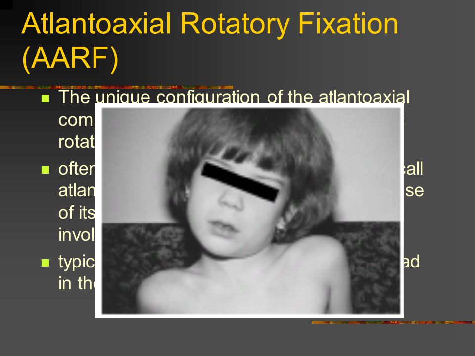Atlantoaxial Rotatory Fixation: New Diagnostic Paradigm And A New  Classification Based On Motion Analysisi Using Computed Tomographic Imaging  CGMH Chia. - ppt download