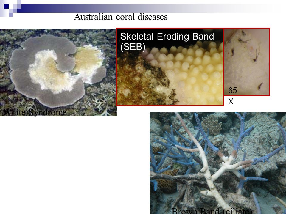 Skeletal Eroding Band (SEB) 65 X Brown Band (ciliate) White Syndrome Australian coral diseases