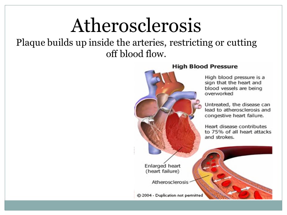 Atherosclerosis Plaque builds up inside the arteries, restricting or cutting off blood flow.