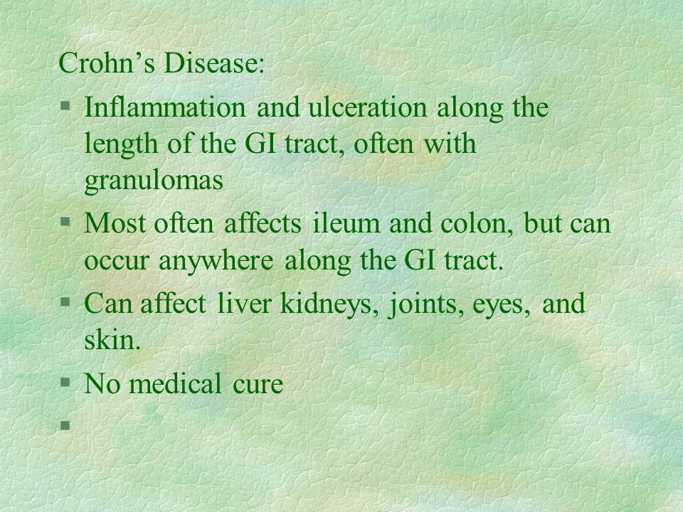 Crohn’s Disease: §Inflammation and ulceration along the length of the GI tract, often with granulomas §Most often affects ileum and colon, but can occur anywhere along the GI tract.