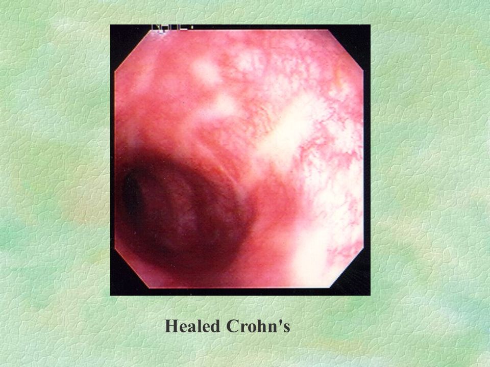 Healed Crohn s