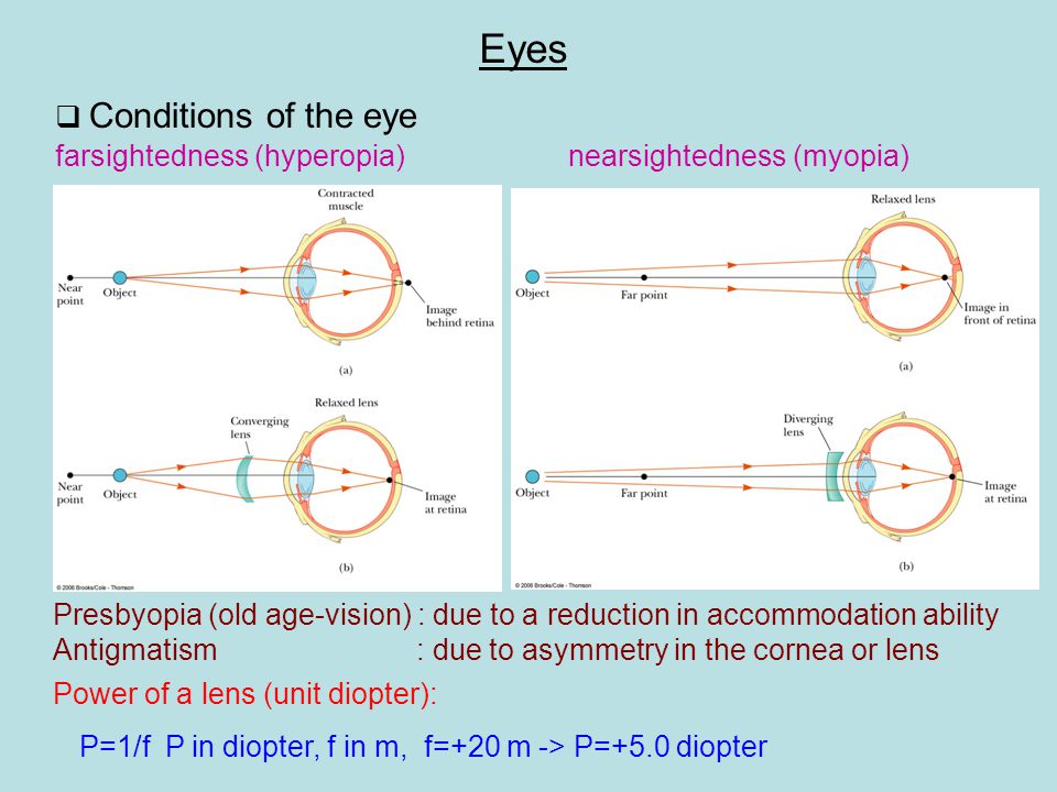 Eyes  Conditions of the eye farsightedness (hyperopia)nearsightedness (myopia) Presbyopia (old age-vision) : due to a reduction in accommodation ability Antigmatism : due to asymmetry in the cornea or lens Power of a lens (unit diopter): P=1/f P in diopter, f in m, f=+20 m -> P=+5.0 diopter