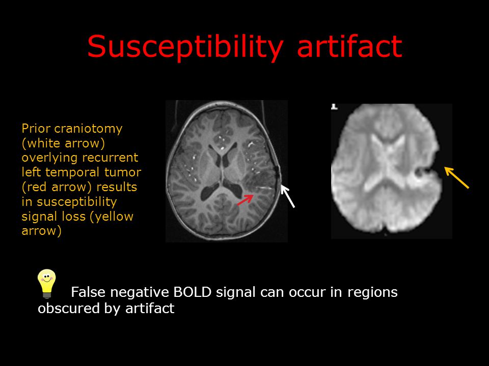 Susceptibility artifact False negative BOLD signal can occur in regions obscured by artifact Prior craniotomy (white arrow) overlying recurrent left temporal tumor (red arrow) results in susceptibility signal loss (yellow arrow)