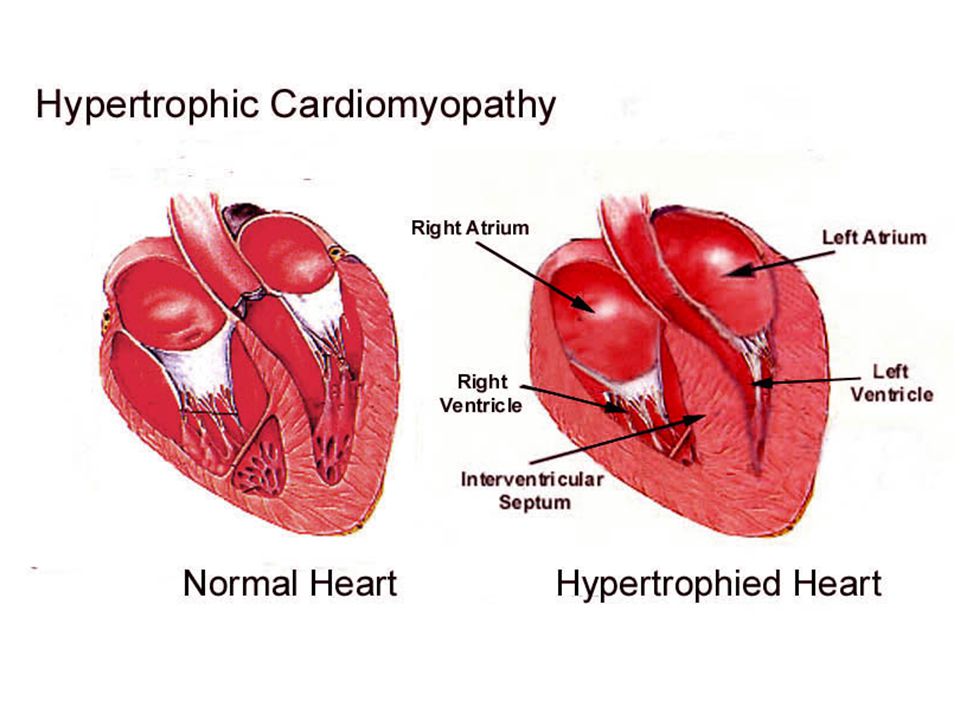 Гипертрофия сердца. Гипертрофия миокарда левого желудочка. Миокард левого желудочка. Гипертрофическая кардиомиопатия сердце.