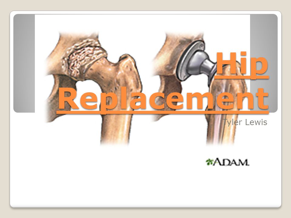 Hip Replacement Tyler Lewis