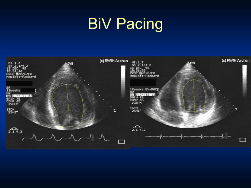 BiV Pacing