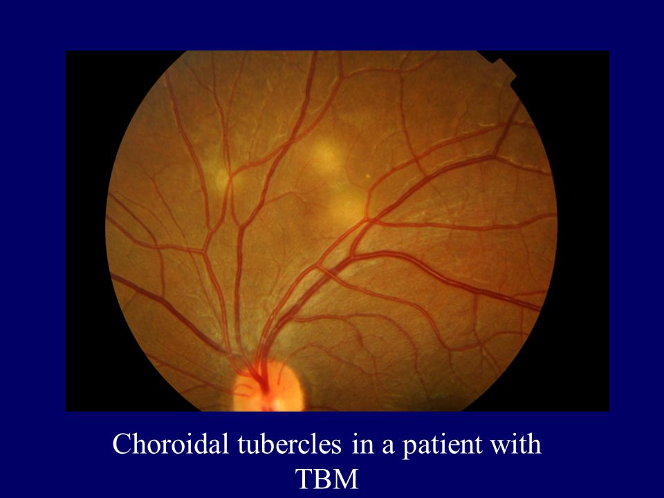 choroidal tubercles