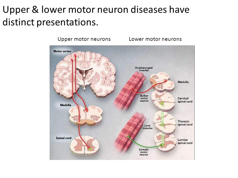 Upper & lower motor neuron diseases have distinct presentations.