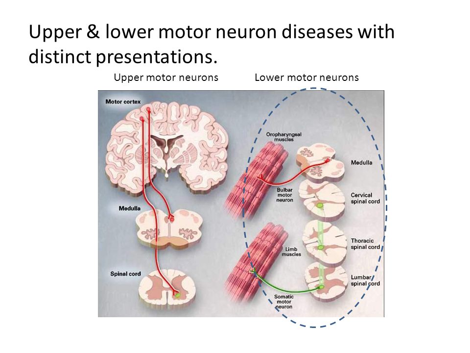 Upper & lower motor neuron diseases with distinct presentations.