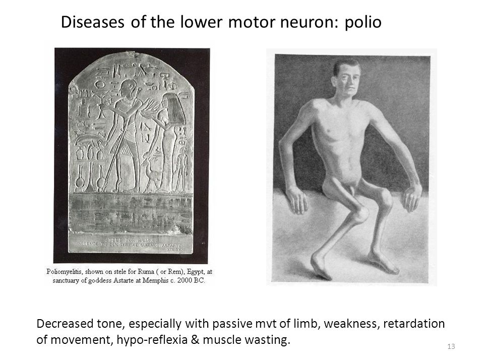13 Diseases of the lower motor neuron: polio Decreased tone, especially with passive mvt of limb, weakness, retardation of movement, hypo-reflexia & muscle wasting.