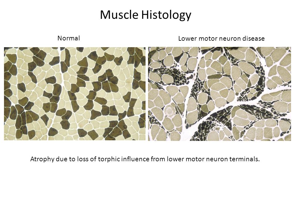 Muscle Histology Normal Lower motor neuron disease Atrophy due to loss of torphic influence from lower motor neuron terminals.