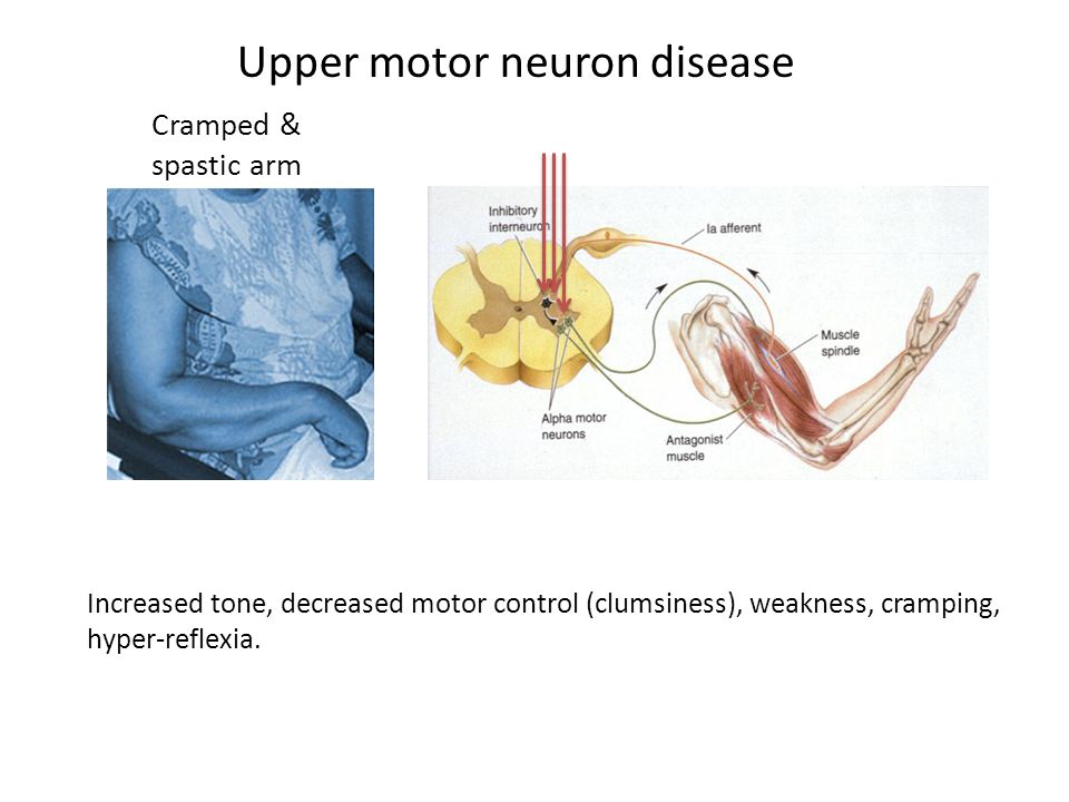 Cramped & spastic arm Upper motor neuron disease Increased tone, decreased motor control (clumsiness), weakness, cramping, hyper-reflexia.