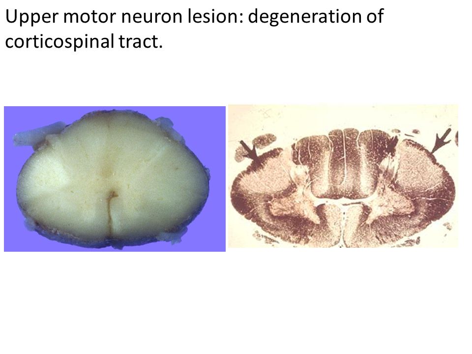 Upper motor neuron lesion: degeneration of corticospinal tract.