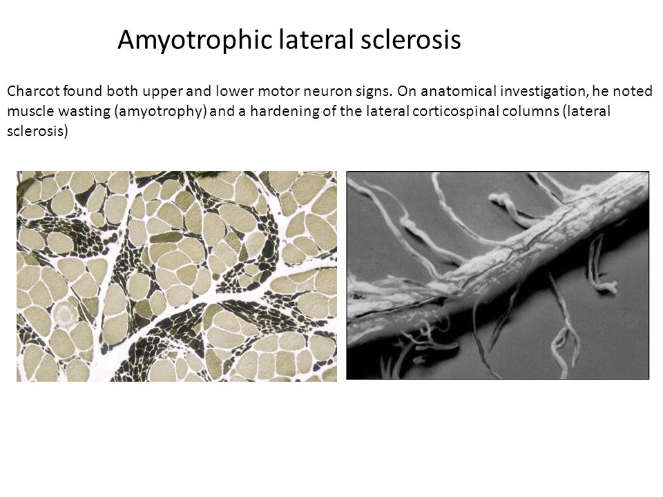 Amyotrophic lateral sclerosis Charcot found both upper and lower motor neuron signs.