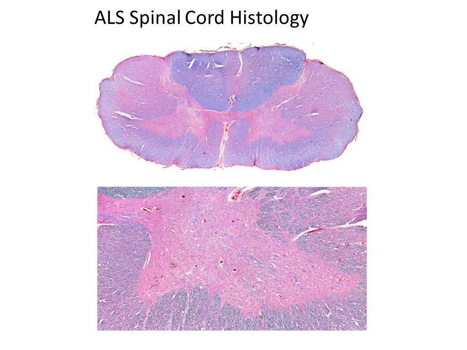 ALS Spinal Cord Histology