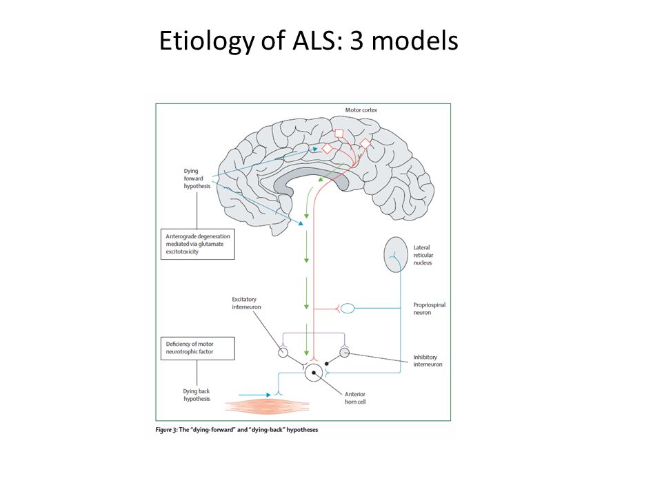 Etiology of ALS: 3 models