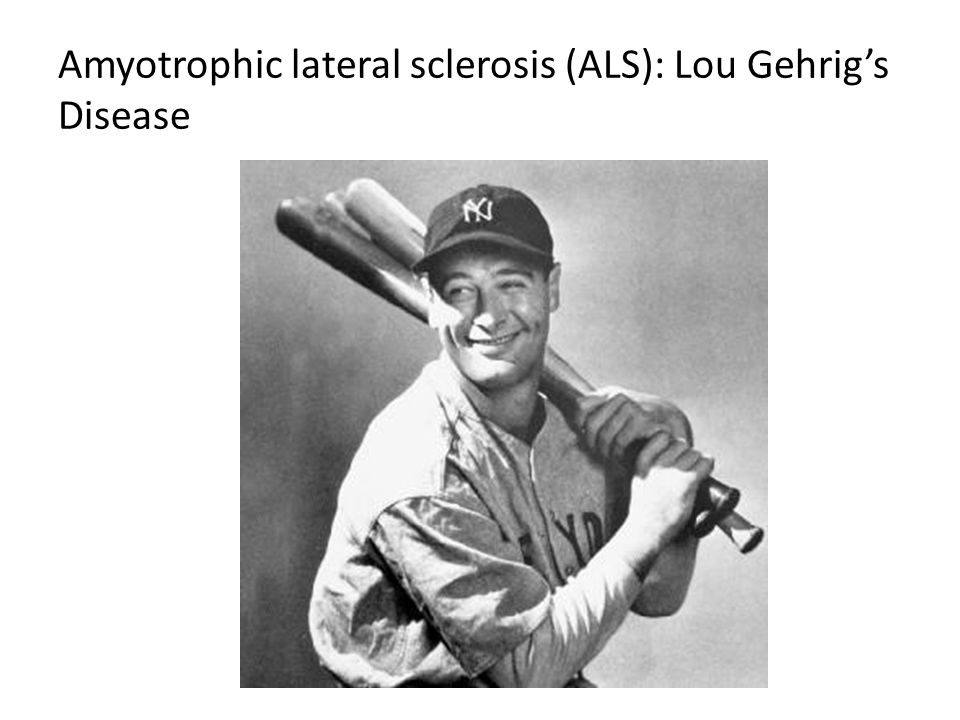 Amyotrophic lateral sclerosis (ALS): Lou Gehrig’s Disease