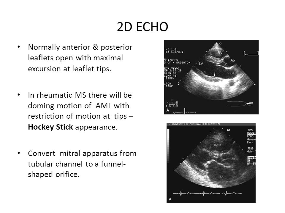 ECHOCARDIOGRAPHIC EVALUATION OF MITRAL STENOSIS Dr Binjo J Vazhappilly  Senior Resident. - ppt download