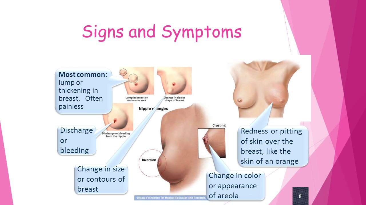 discharge from the areola of the breast Discharge from the areola of the breast