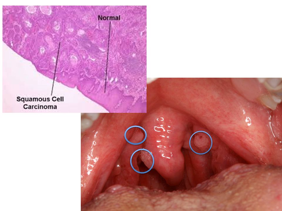 hpv genital warts and cancer)