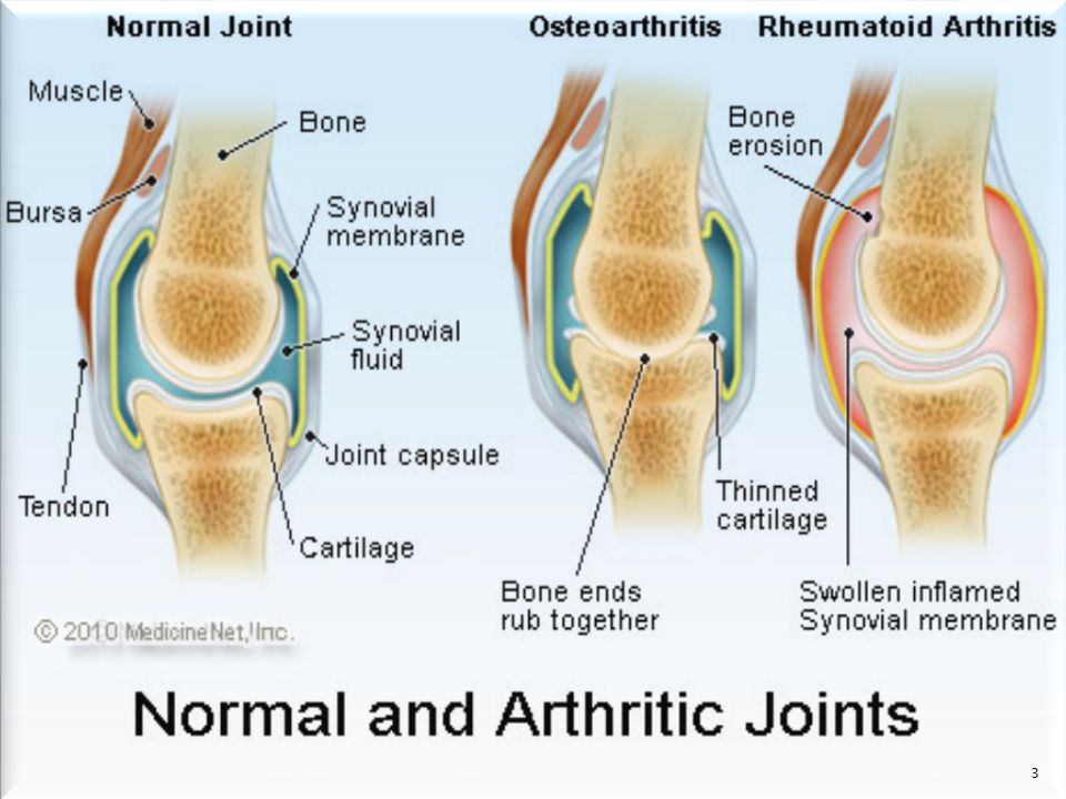 Чем отличается артроз от. Ревматоидный артрит плечевого сустава. Остеоартрит и ревматоидный артрит. Ревматоидный артрит и артроз.