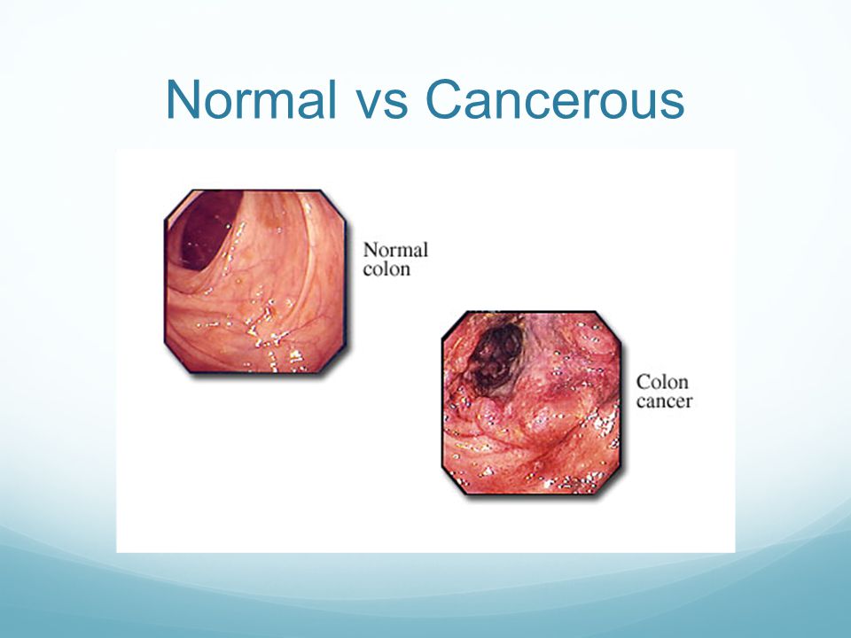 Normal vs Cancerous