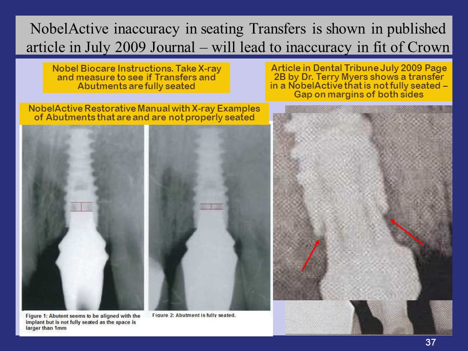 37 NobelActive inaccuracy in seating Transfers is shown in published article in July 2009 Journal – will lead to inaccuracy in fit of Crown Article in Dental Tribune July 2009 Page 2B by Dr.