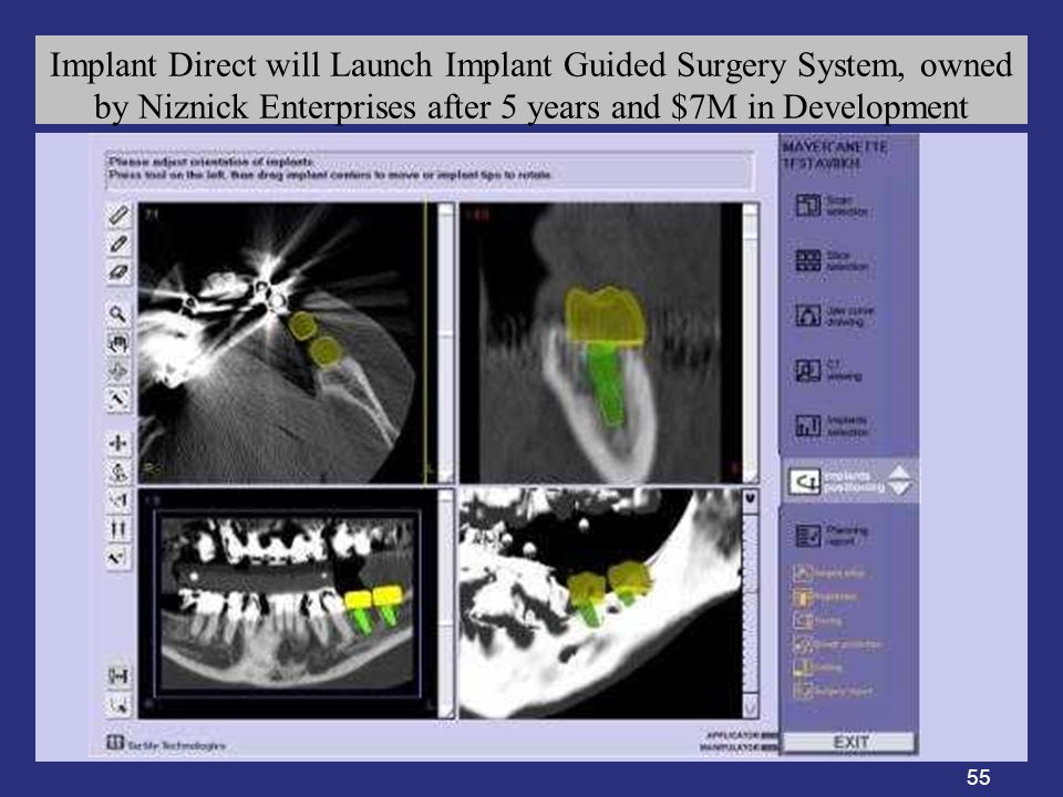 55 Implant Direct will Launch Implant Guided Surgery System, owned by Niznick Enterprises after 5 years and $7M in Development
