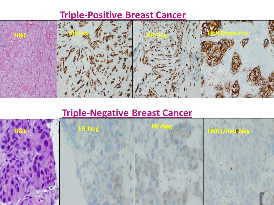 Triple-Positive Breast Cancer Triple-Negative Breast Cancer H&E ER-Neg PR-Neg HER2/neu-Neg ER-Pos PR-Pos HER2/neu-Pos H&E