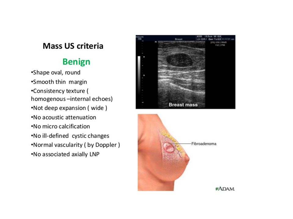 round breast lump Round breast lump