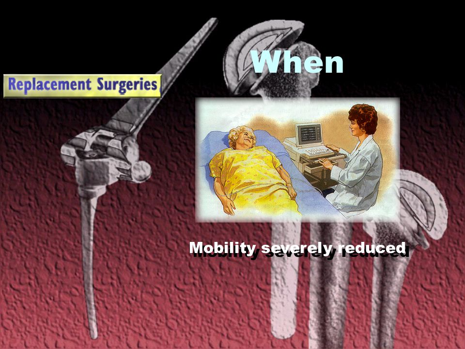 When Mobility severely reduced