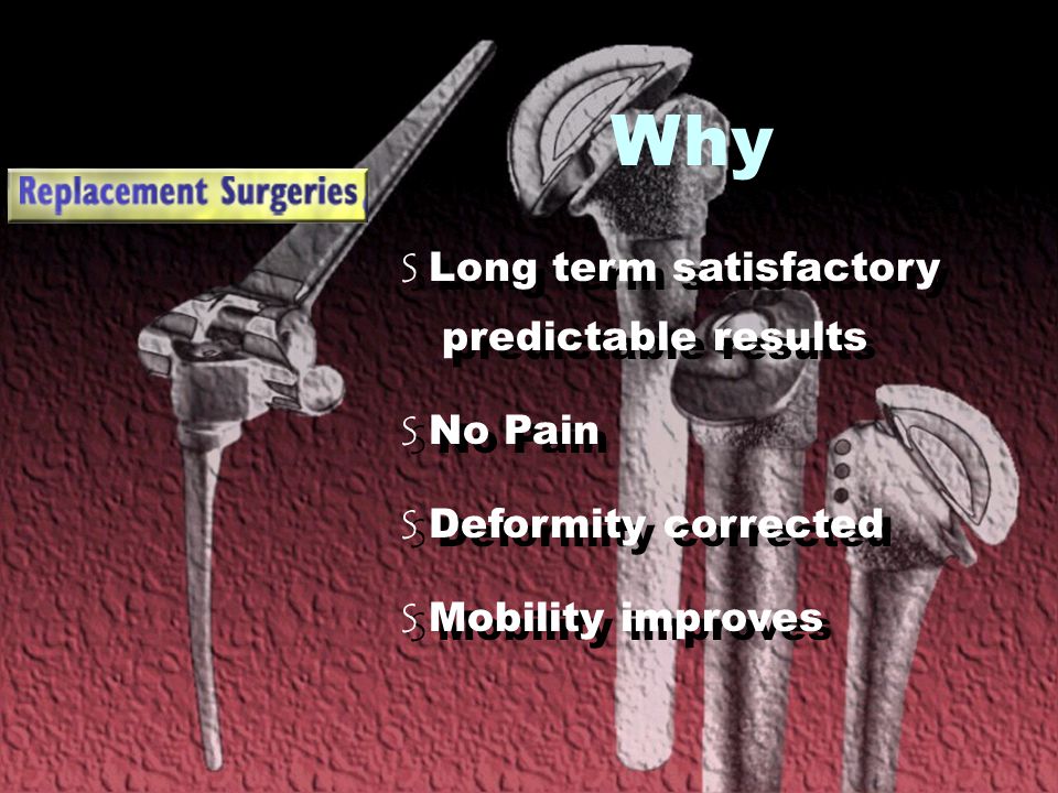 Why S Long term satisfactory predictable results S No Pain S Deformity corrected S Mobility improves S Long term satisfactory predictable results S No Pain S Deformity corrected S Mobility improves