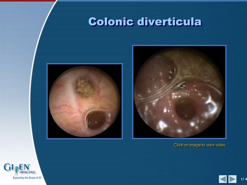 17 Click on image to view video Colonic diverticula