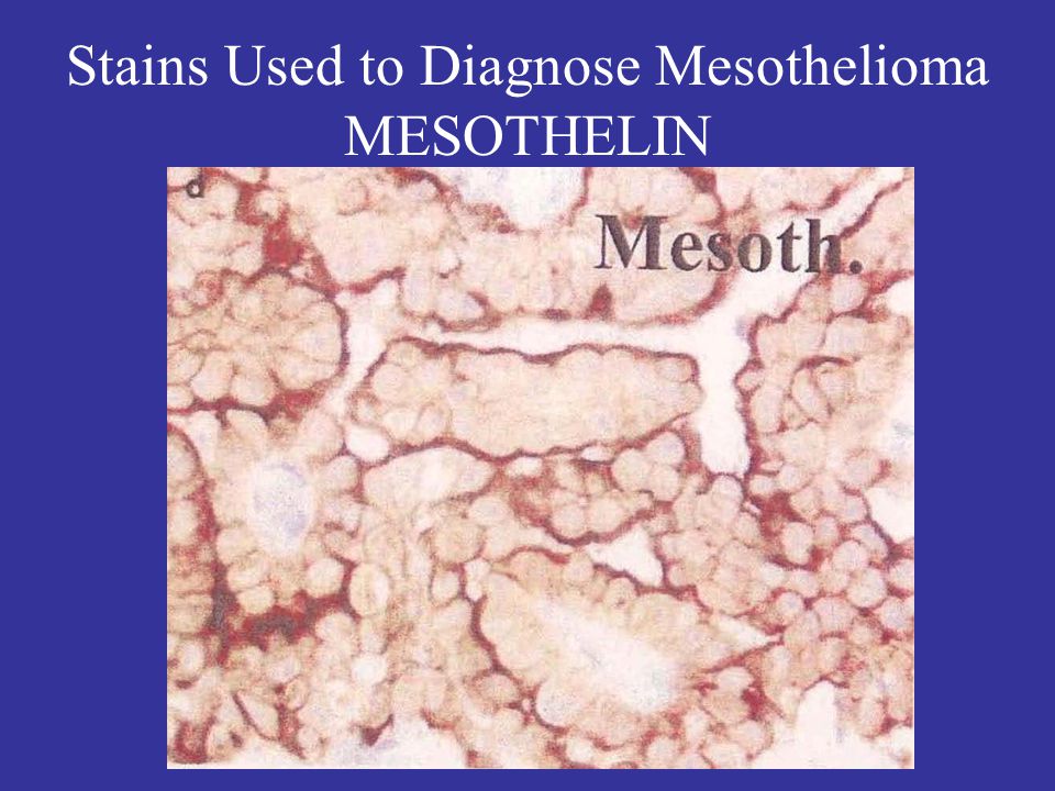 Stains Used to Diagnose Mesothelioma MESOTHELIN