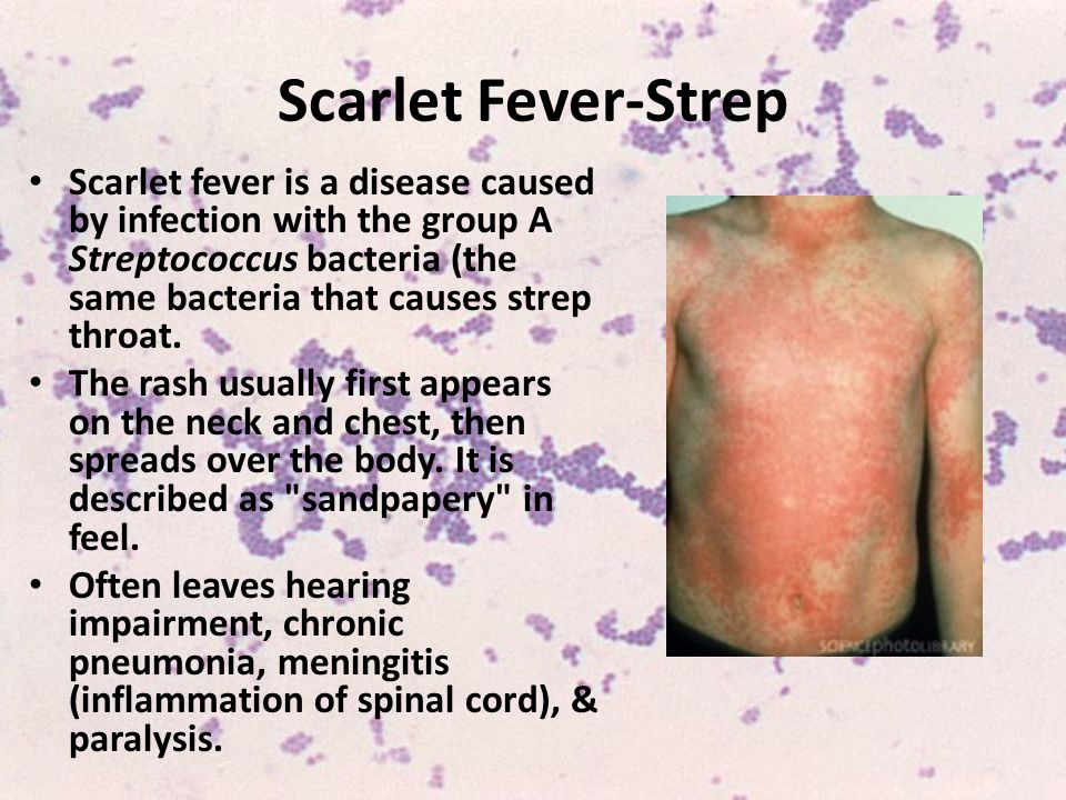 Information about Scarlet Fever, Nexles