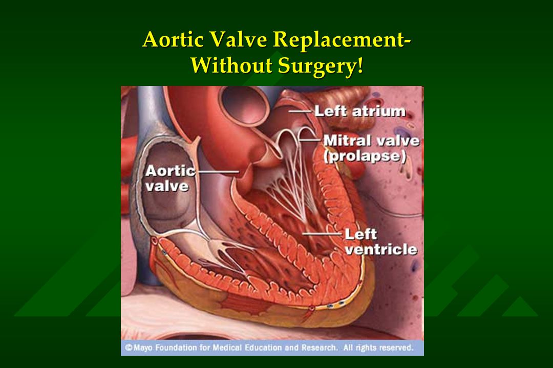 Aortic Valve Replacement- Without Surgery!