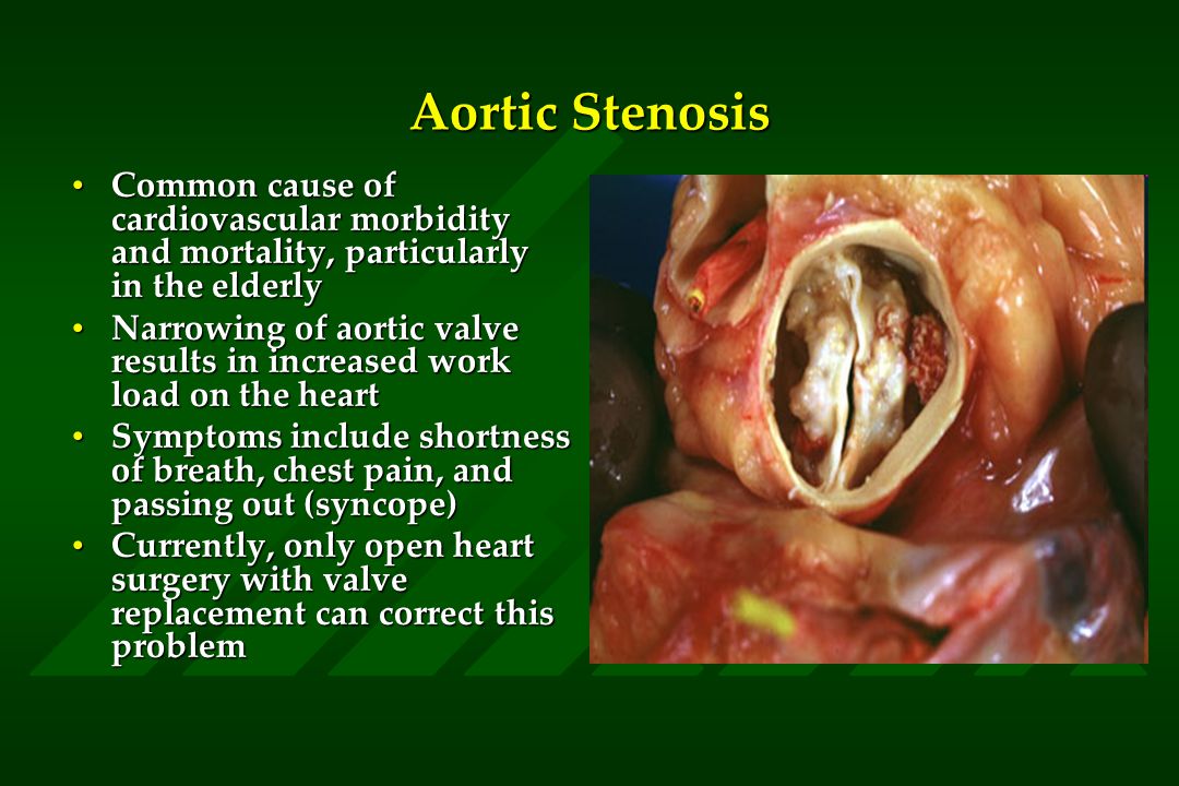 Aortic Stenosis Common cause of cardiovascular morbidity and mortality, particularly in the elderlyCommon cause of cardiovascular morbidity and mortality, particularly in the elderly Narrowing of aortic valve results in increased work load on the heartNarrowing of aortic valve results in increased work load on the heart Symptoms include shortness of breath, chest pain, and passing out (syncope)Symptoms include shortness of breath, chest pain, and passing out (syncope) Currently, only open heart surgery with valve replacement can correct this problemCurrently, only open heart surgery with valve replacement can correct this problem