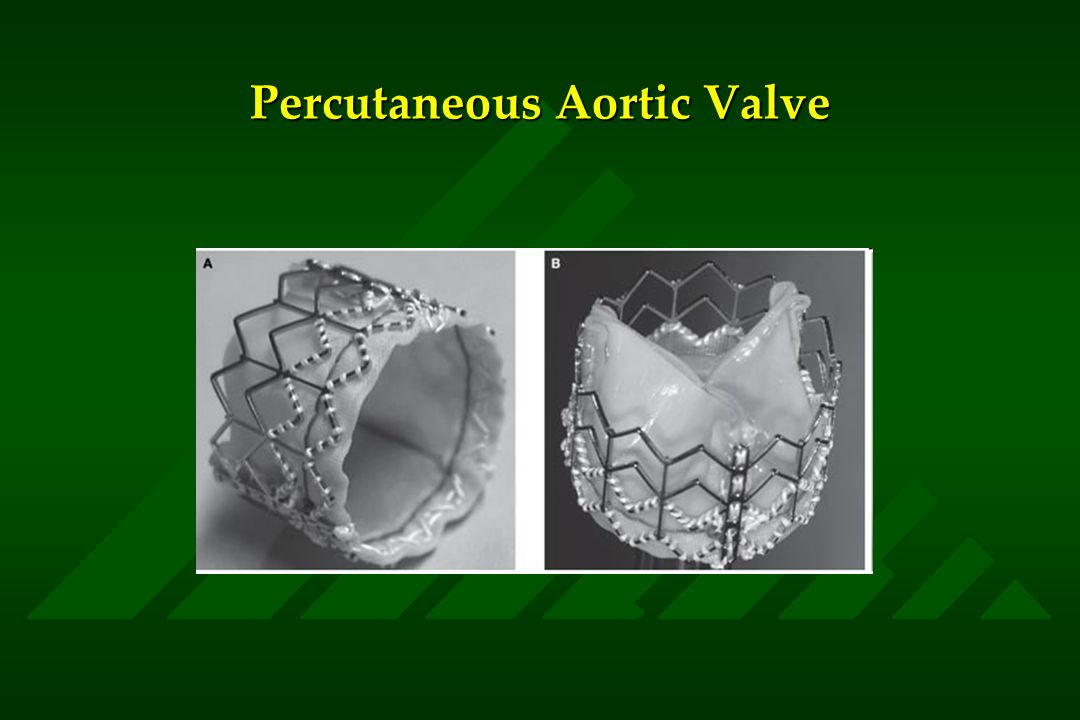 Percutaneous Aortic Valve